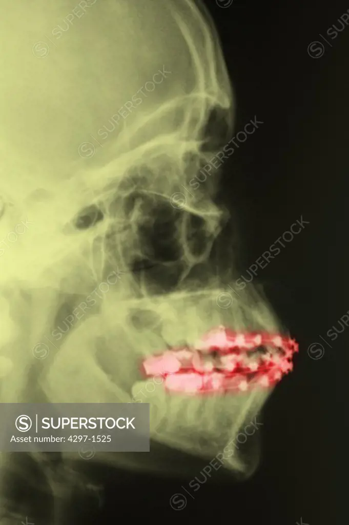 Colorized lateral skull x-ray of a child with orthodontic braces
