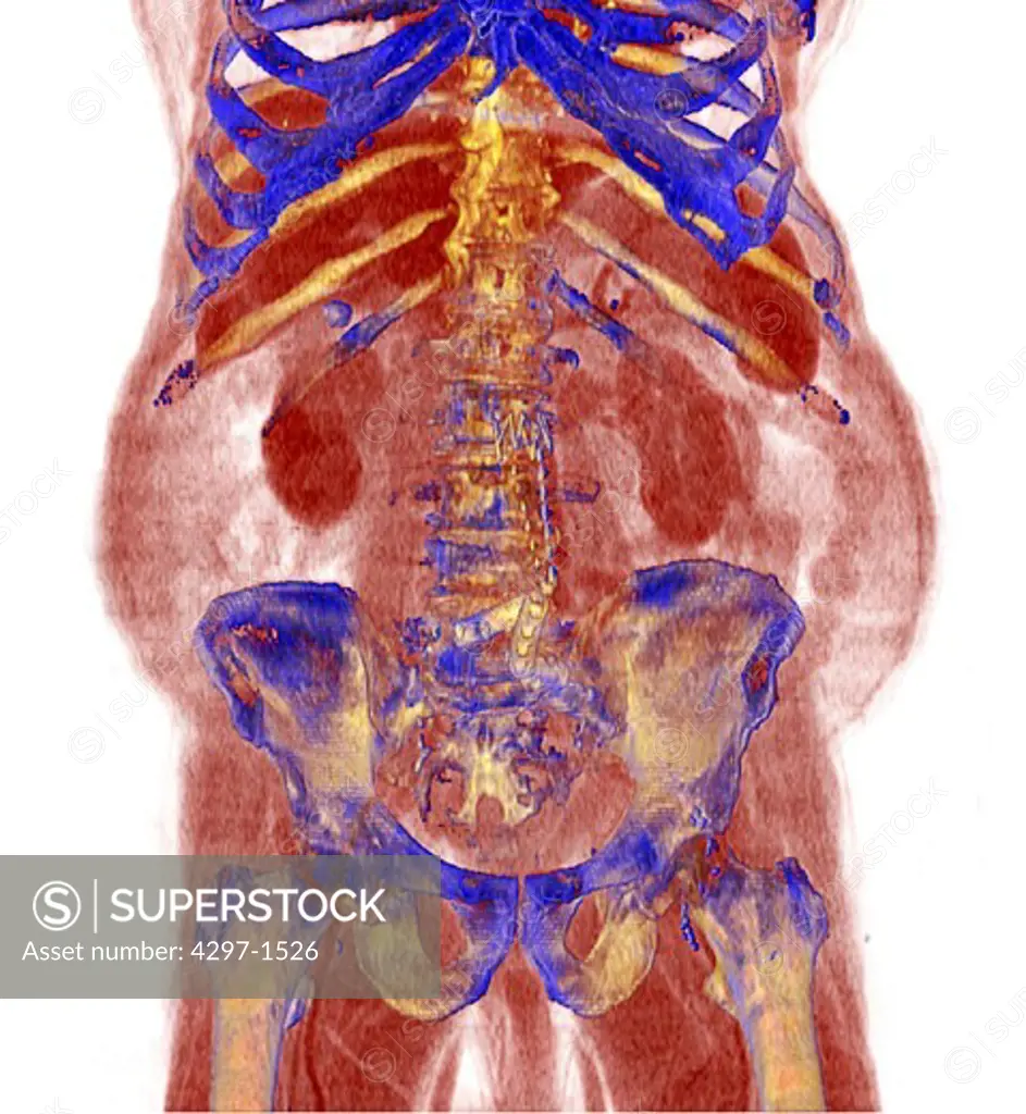 3D CT scan of an obese person who has undergone surgery for an abdominal aortic aneurysm, repaired with a graft