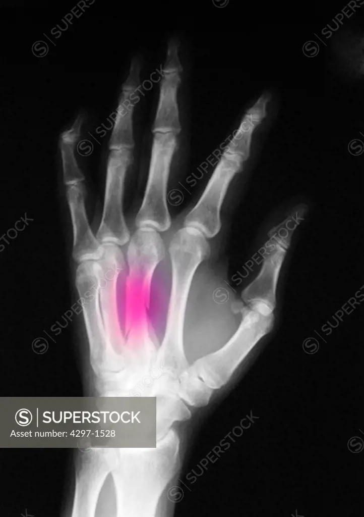 Colorized x-ray of a hand showing a middle metacarpal fracture