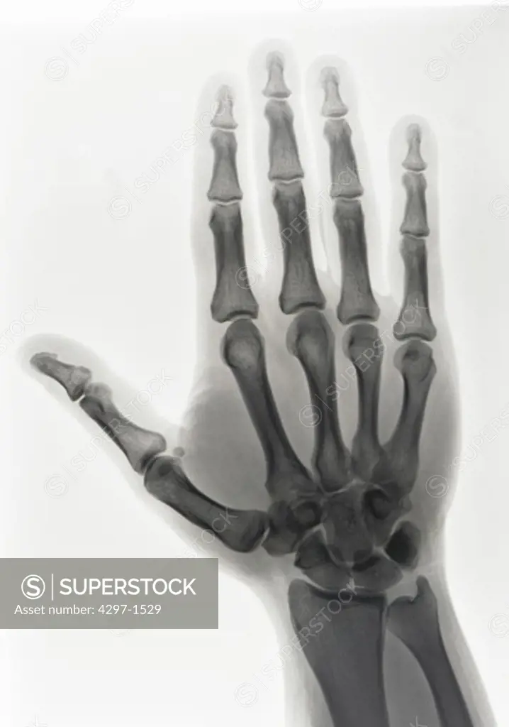 X-ray of a normal hand