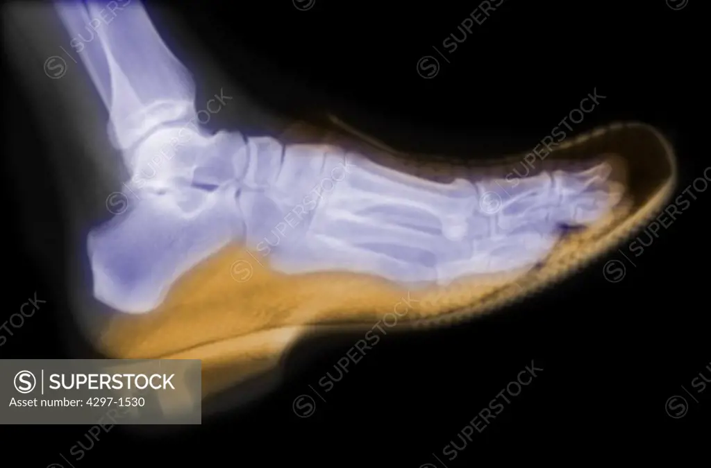 X-ray of an adult foot in a clog shoe