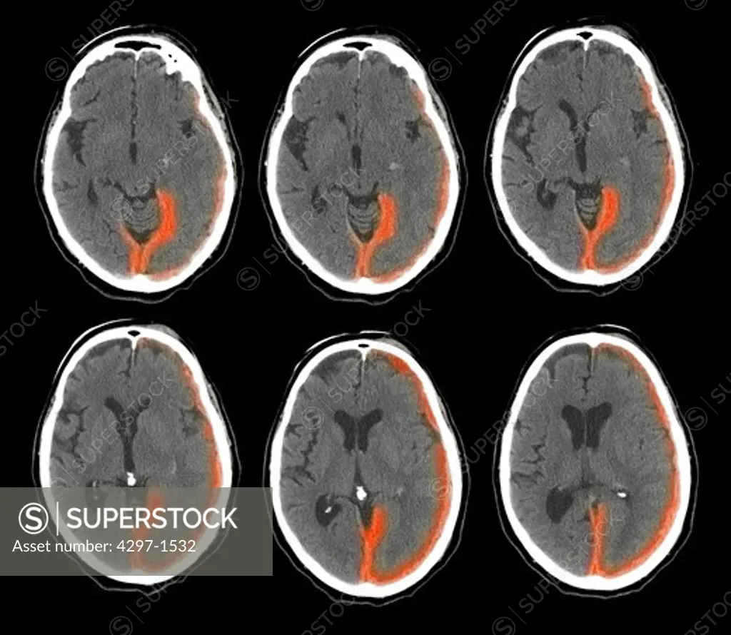 Colorized axial CT scan images of the brain of a 73 year old man who fell, hitting his head, and developed a subdural hematoma of the brain
