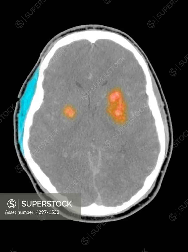 Colorized axial CT scan images of the brain of a 16 year old boy who fell, hitting his head, and developed a intracranial bleeding. The areas of bleeding in the brain are highlighted in orange. A hematoma of the scalp is shown in blue