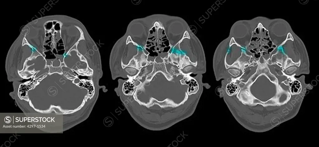 CT scan of the head of a 16 year old boy showing fractures of the facial bones, highlighted in blue
