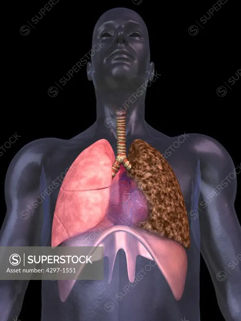 Illustration of the human lungs showing a normal right lung and the effect of smoking (left lung)