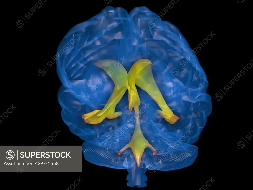 Illustration of the human brain showing the anatomical relationships between the ventricles and the surface of the brain. The ventricular system are the structures containing the cerebrospinal fluid