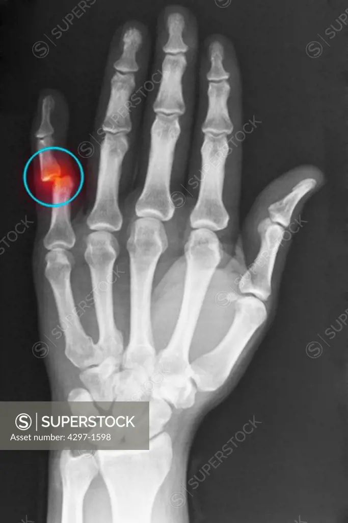 Hand x-ray of an adult man showing a dislocation of the fifth finger at the proximal interphalangeal joint
