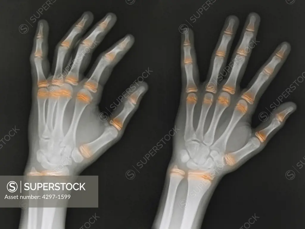 Hand x-ray of a 12 year old boy showing the growth centers (highlighted in orange)