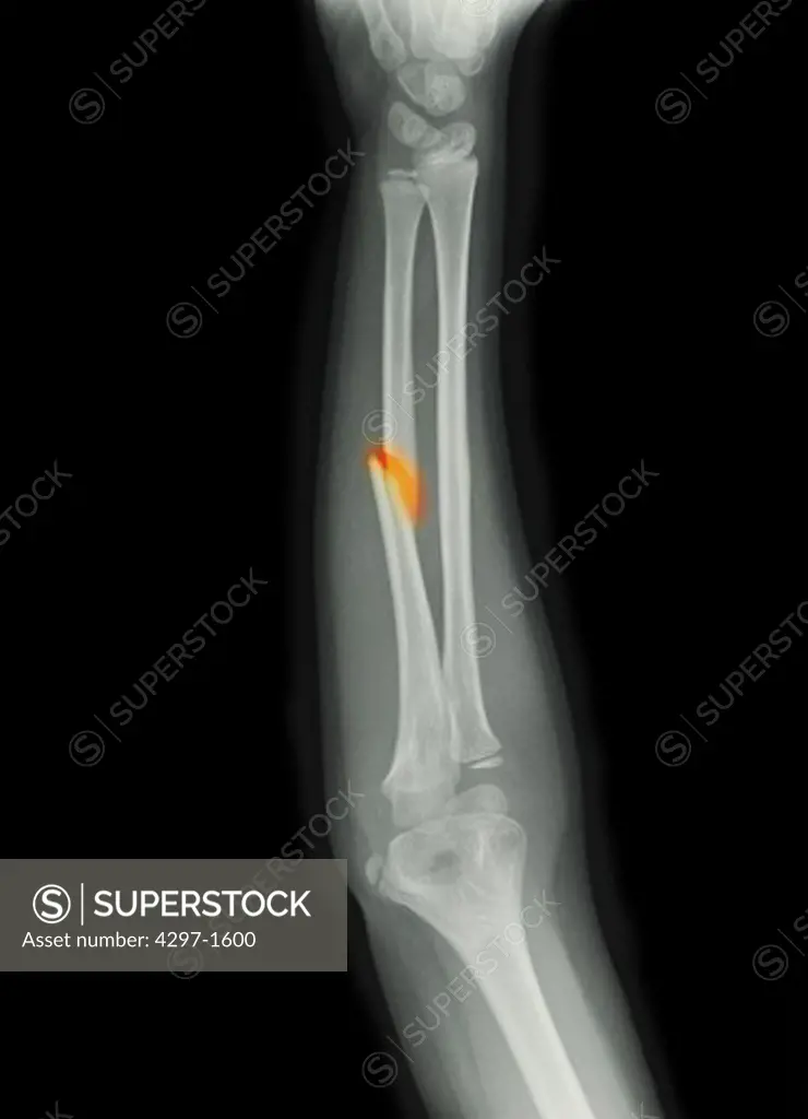 Forearm x-ray of an 8 year old boy showing a fracture of the mid-shaft of the ulna