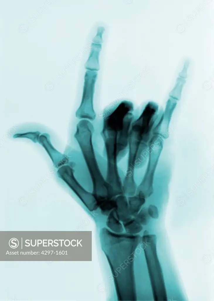 X-ray of a hand showing the gesture for the word love