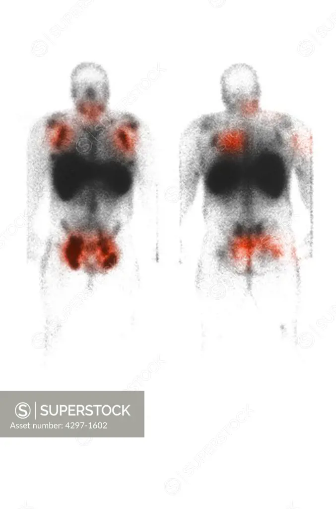 Radionucleotide full body scan showing cancer Radiolabeled monoclonal antibodies confirm that this patient's cutaneous t-cell lymph cancer involves the lymph nodes and skin