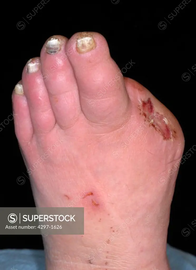 Foot of a 63 year old diabetic woman who had her toe amputated because of poor circulation