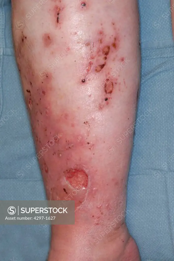 Skin ulcers on the leg of a 63 year old diabetic woman