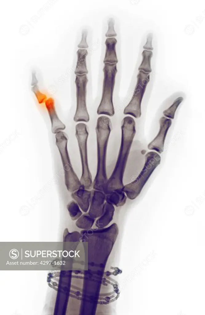 Colorized x-ray of a hand showing a dislocation of the little finger at the distal interphalangeal joint