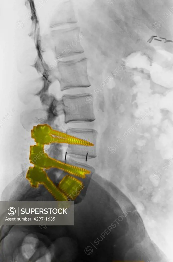 X-ray showing a spinal fusion of the lower lumbar vertebrae