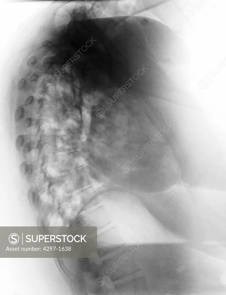 Abnormal chest x-ray showing pneumonia in a 27 year old female with influenza. There are areas of patchy opacification of the lungs bilaterally