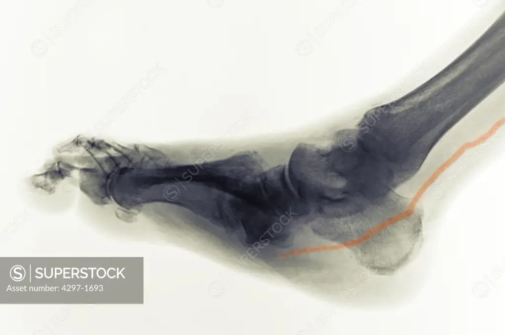 Colorized x-ray of the foot of a person with diabetes who has a calcified artery