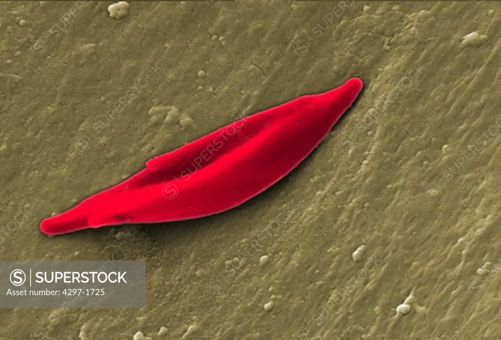 SEM image of a sickle cell red blood cell