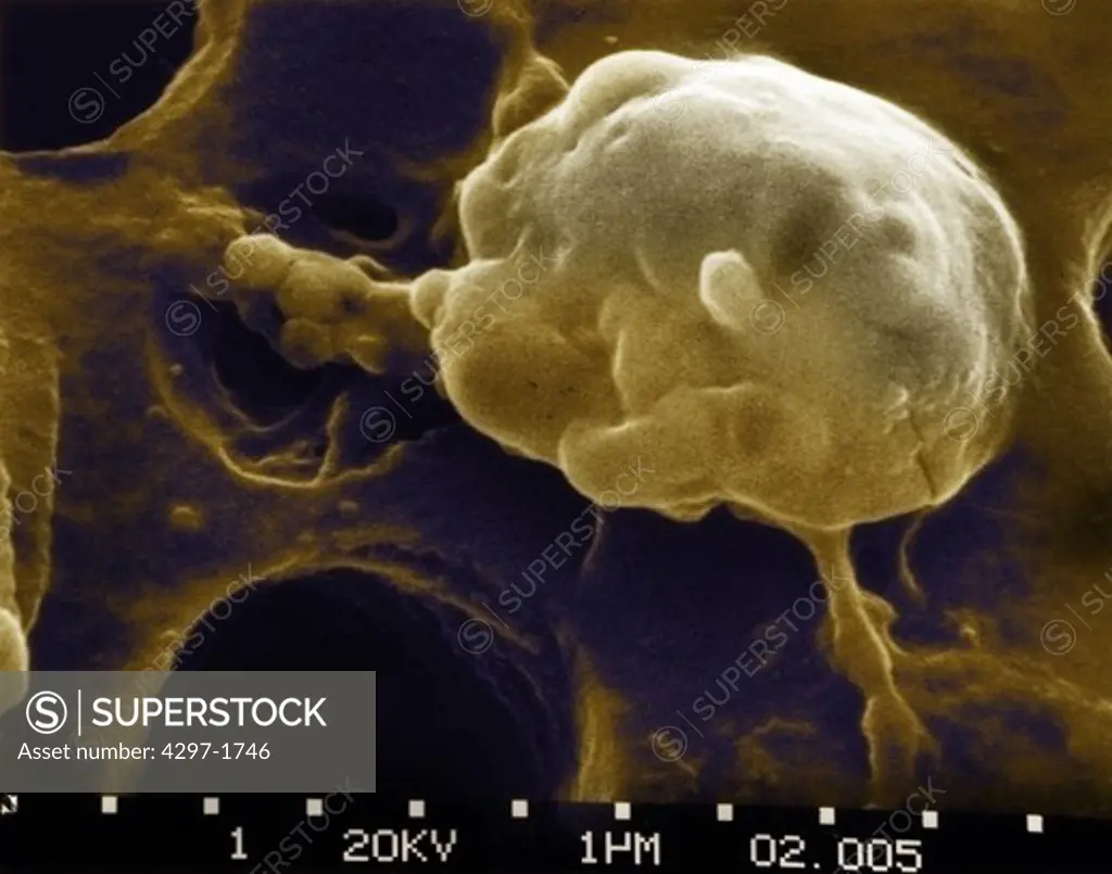 SEM image of the Death of a Cancer Cell (step 5 of a 6 step sequence)