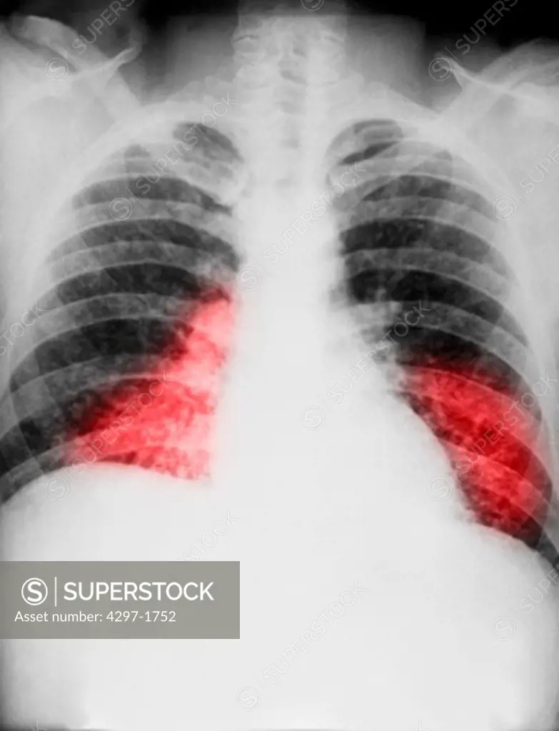 Chest x-ray showing diffuse pulmonary infiltration due to acute pulmonary histoplasmosis caused by H. capsulatum