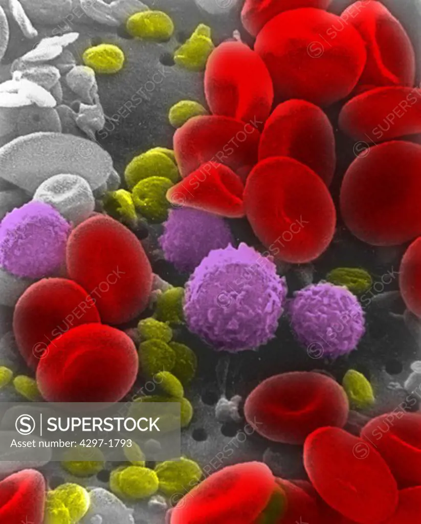 Colorized scanning electron micrograph of human blood cells showing red blood cells (red) white blood cells (purple) and platelets (yellow)