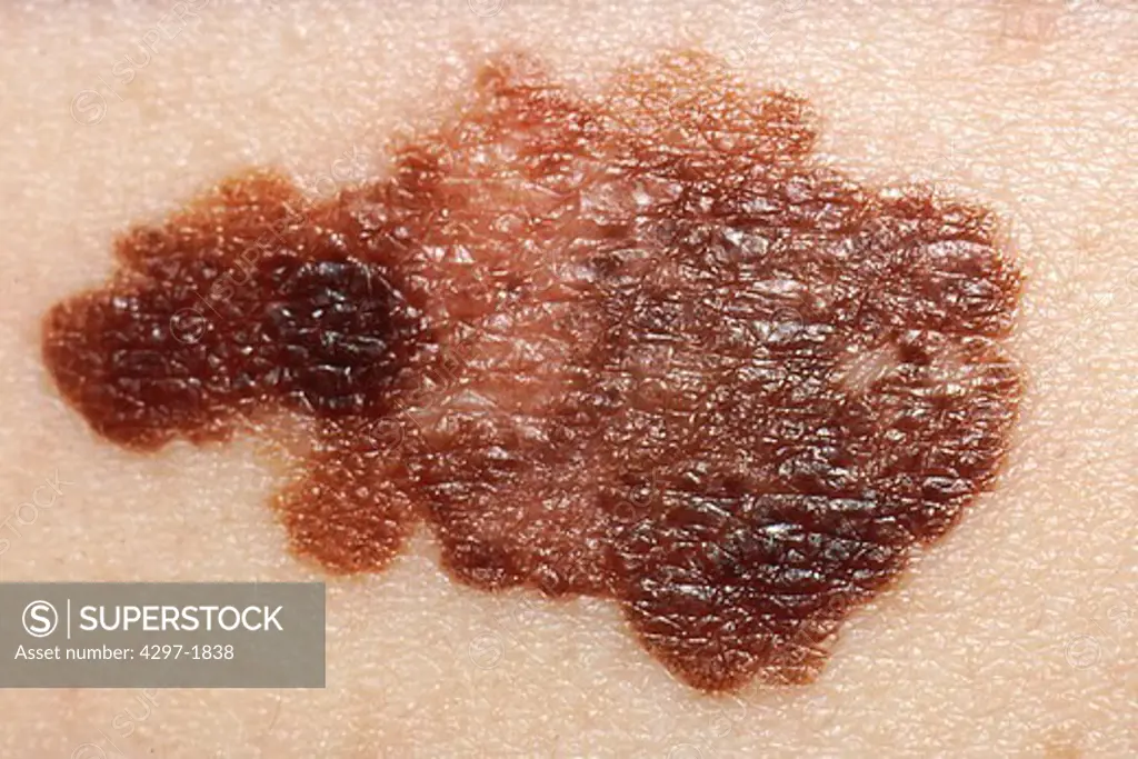 Melanoma skin cancer with coloring of different shades of brown and black or tan
