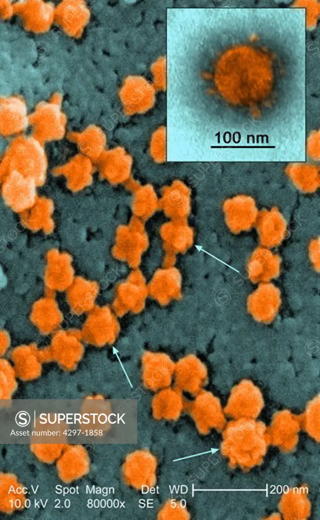 Scanning electron microscopic image of Severe Acute Respiratory Syndrome virus particles