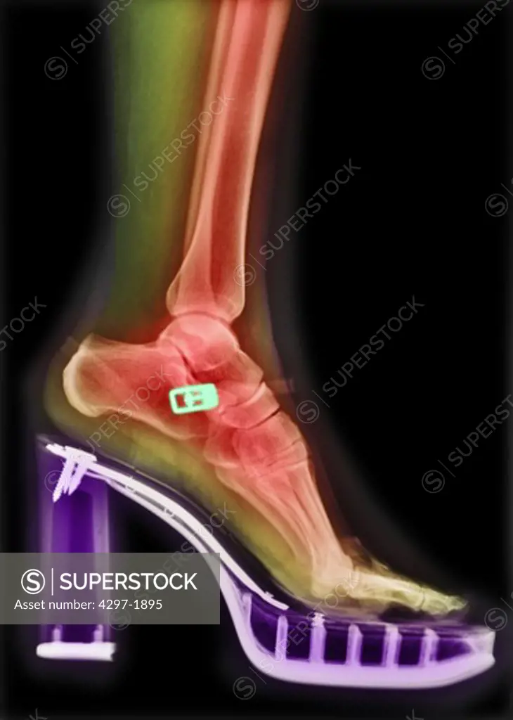 Colorized x-ray of a woman wearing high-heeled shoes