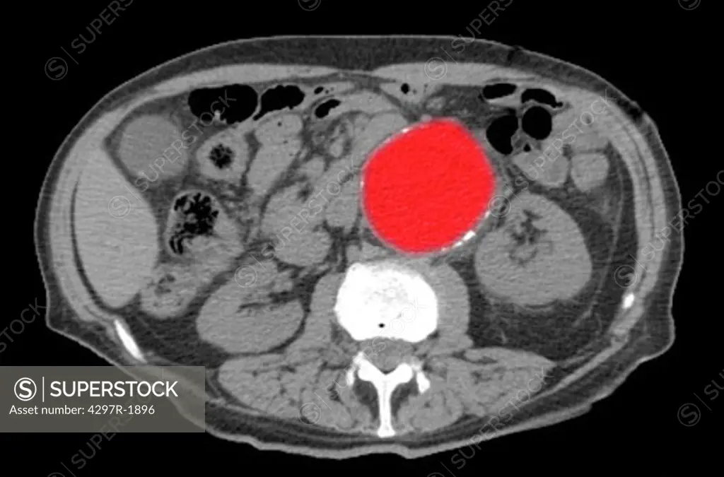 CT scan showing aortic aneurysm. The enlarged and dilated aortic aneurysm is highlighted in red.