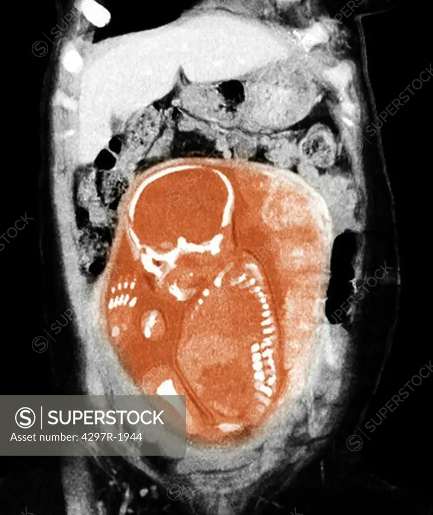 CT scan showing a nearly full term infant in breech position