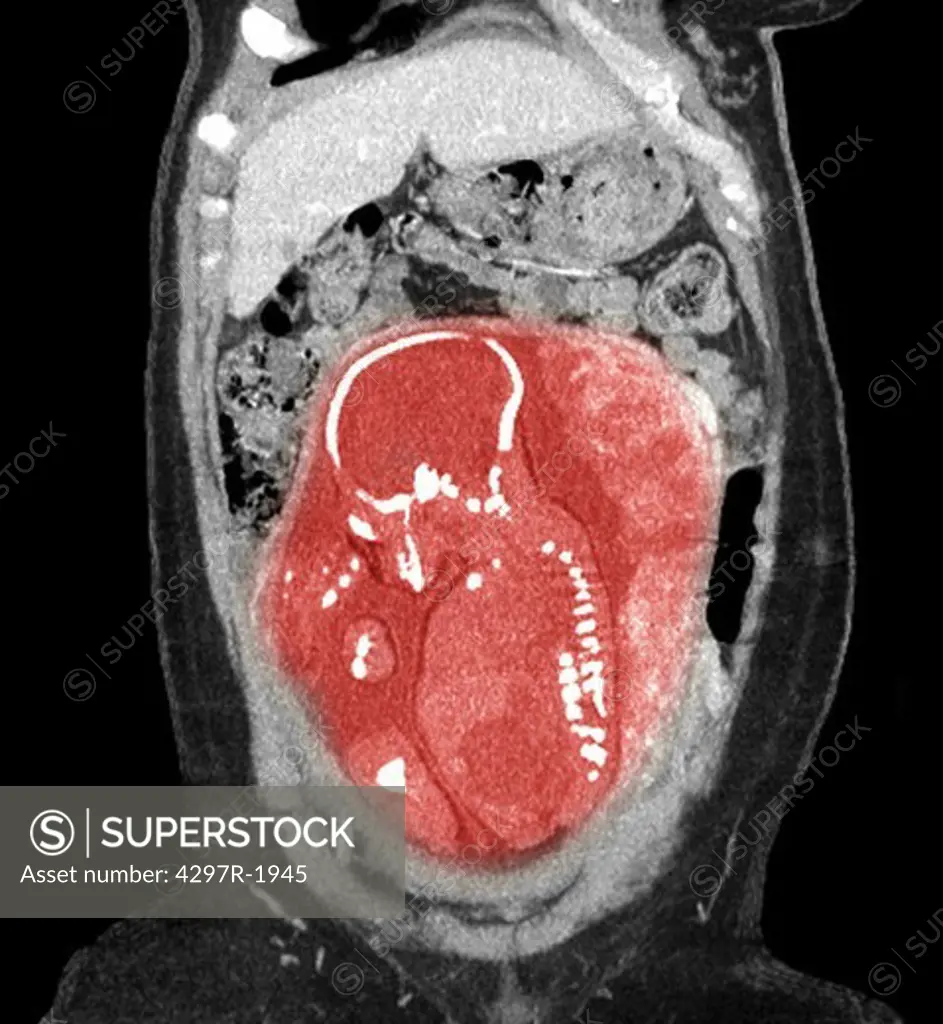 CT scan showing a nearly full term infant in breech position