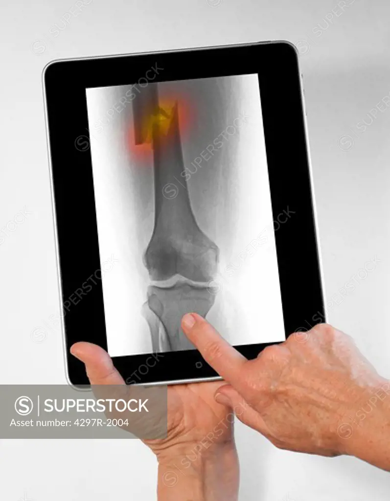 Digital tablet showing an x-ray of a femur fracture
