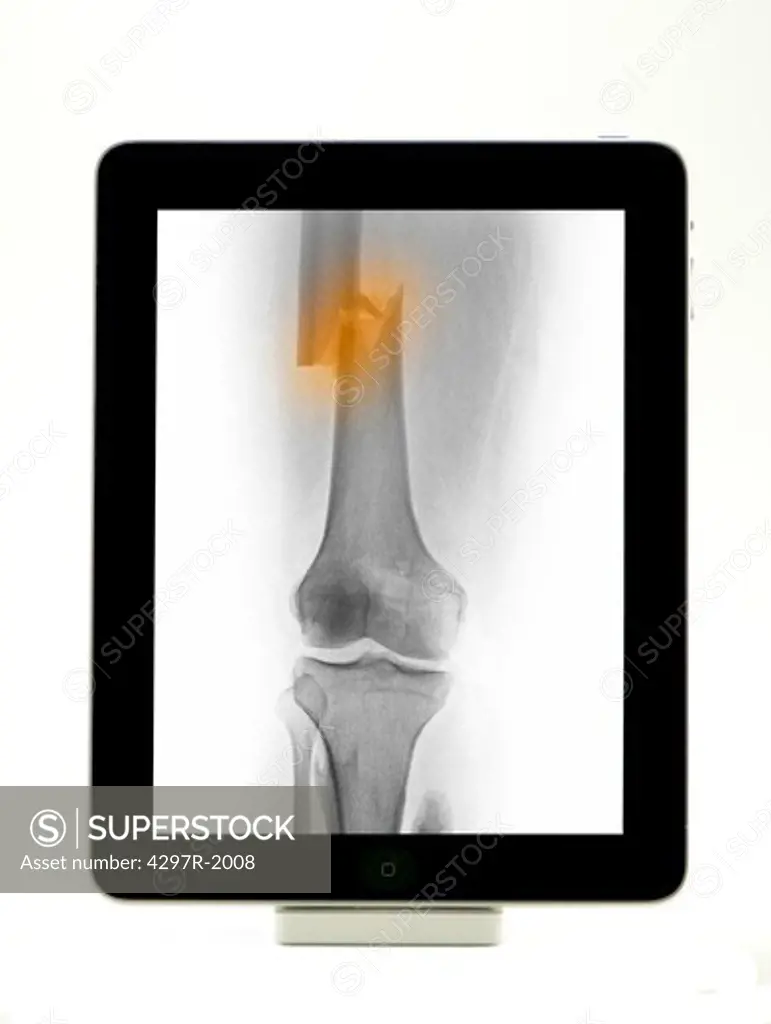 Digital tablet showing an x-ray of human leg