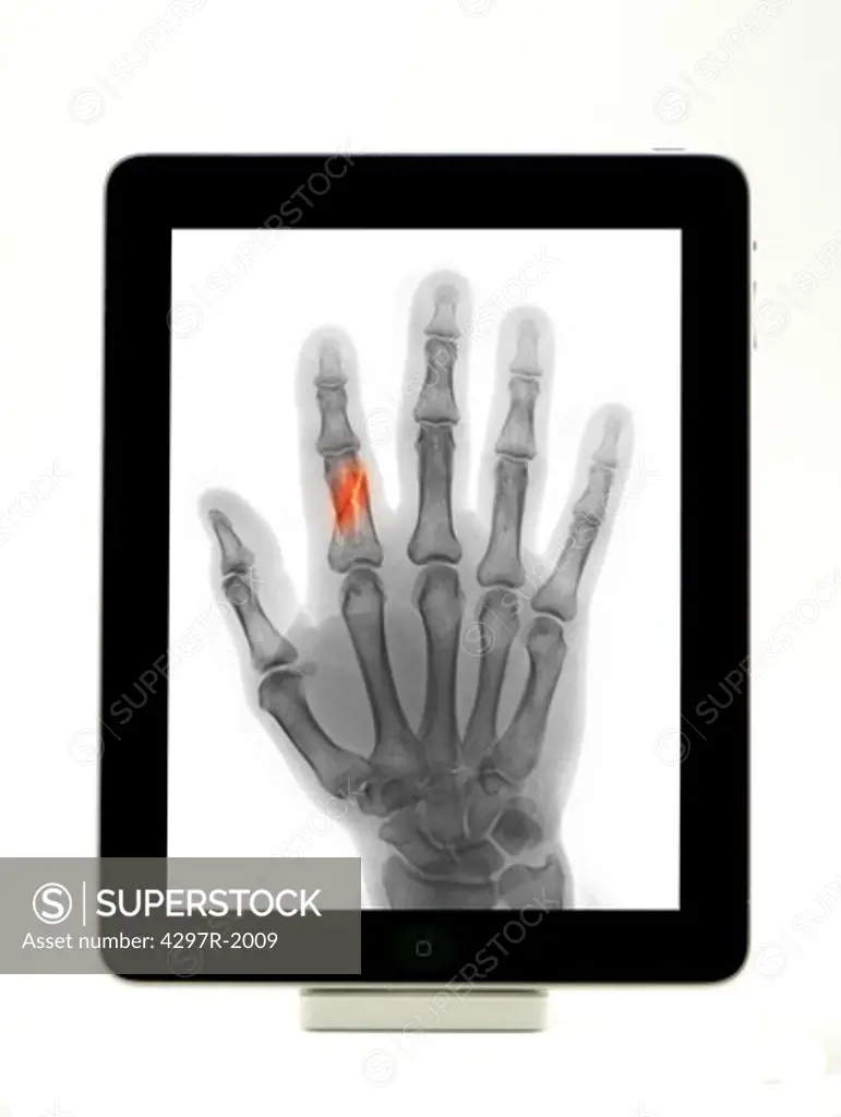 Digital tablet showing an x-ray of a broken finger