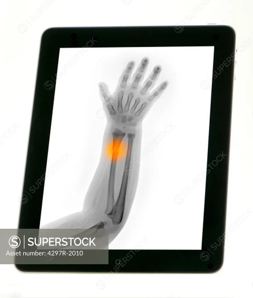Digital tablet showing an x-ray of a young child's forearm which has been fractured during a fall