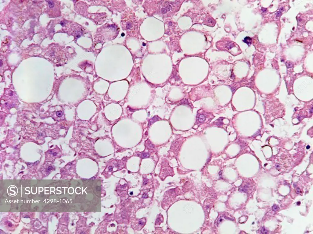 Micrograph of human liver tissue with characteristic vacuolization resulting from fat deposits.  Magnification 400x