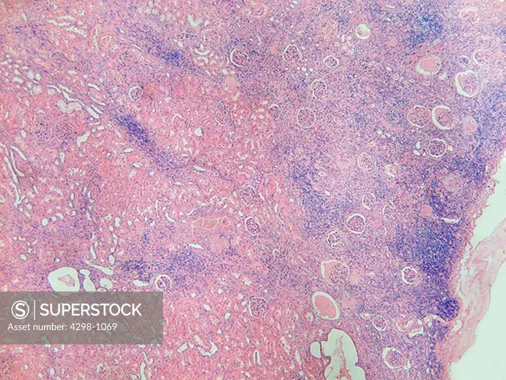 Note the collecting tubules on the left side of the image as contrasted with the right side of the photo where the inflammatory cells (blue) have destroyed most of the tublules.  Magnification 100x