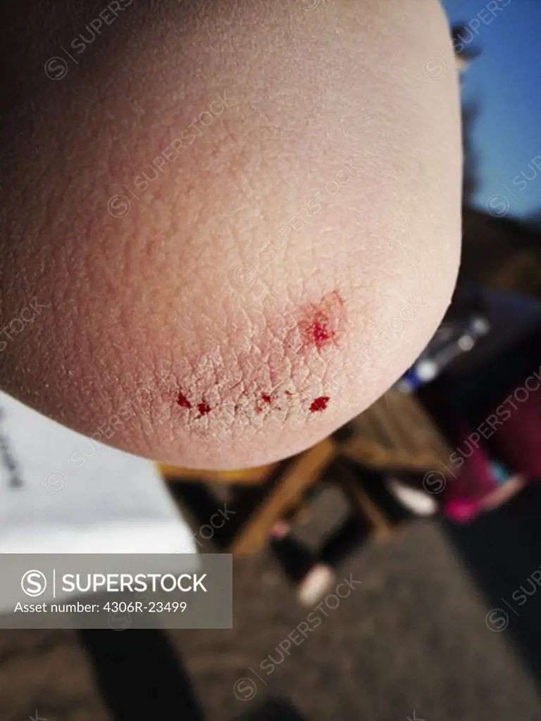 An injured elbow, Sweden.