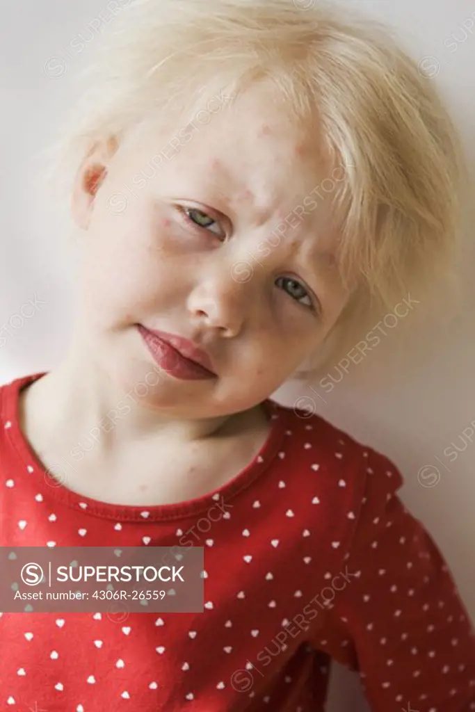 Portrait of girl with chickenpox, studio shot