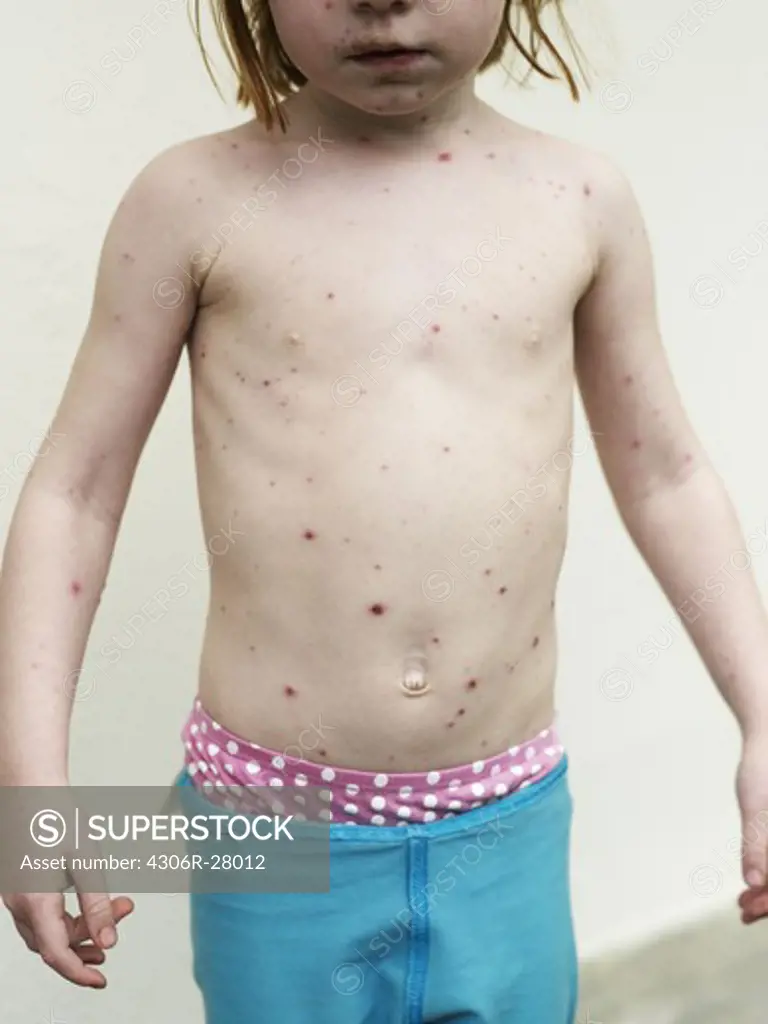 Girl with chickenpox
