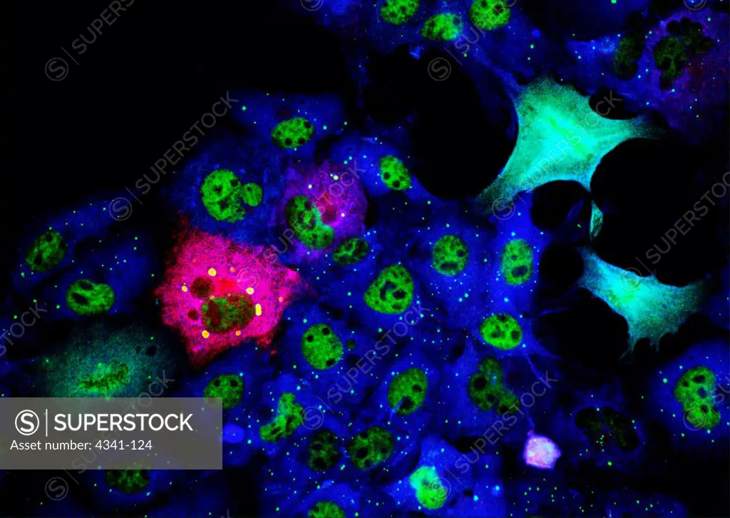 Bloated Red Cells with Mutant Protein, Microscopic View