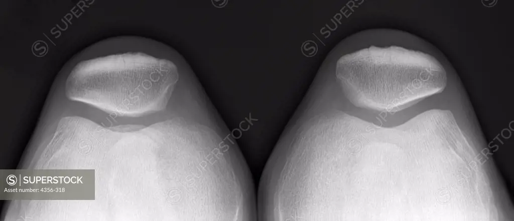 An x-ray of knees, seen from above legs of someone sitting.