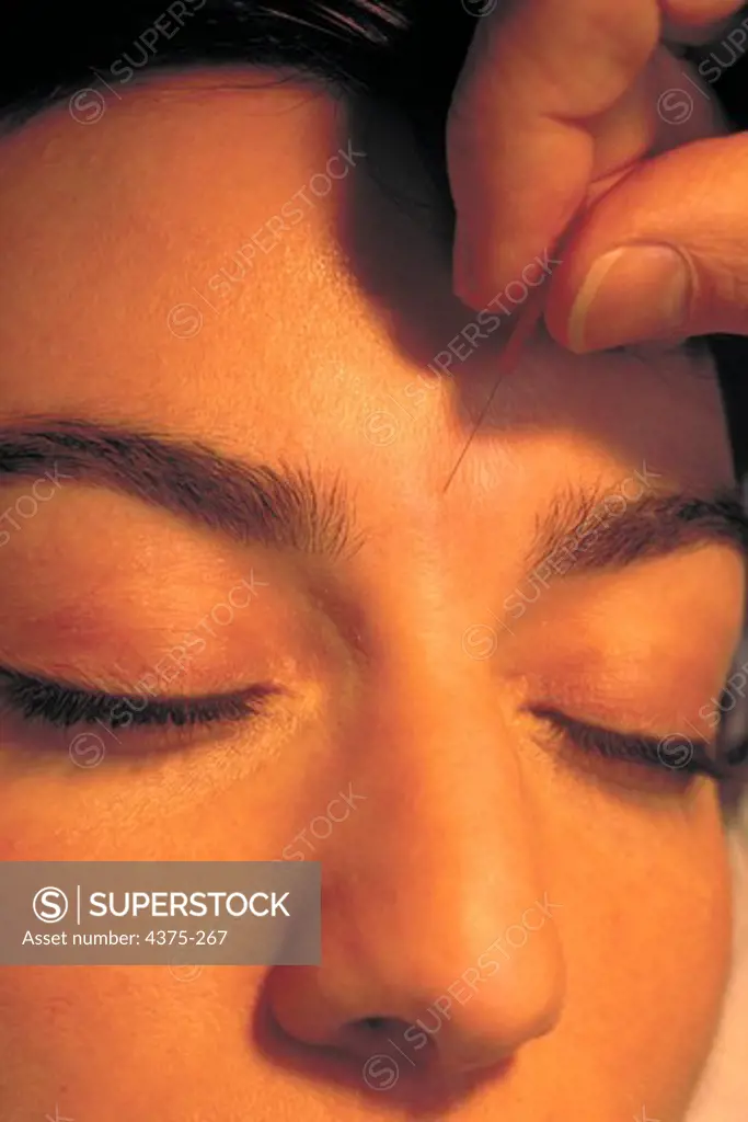Acupuncturist Inserting Needle into Patient's Forehead