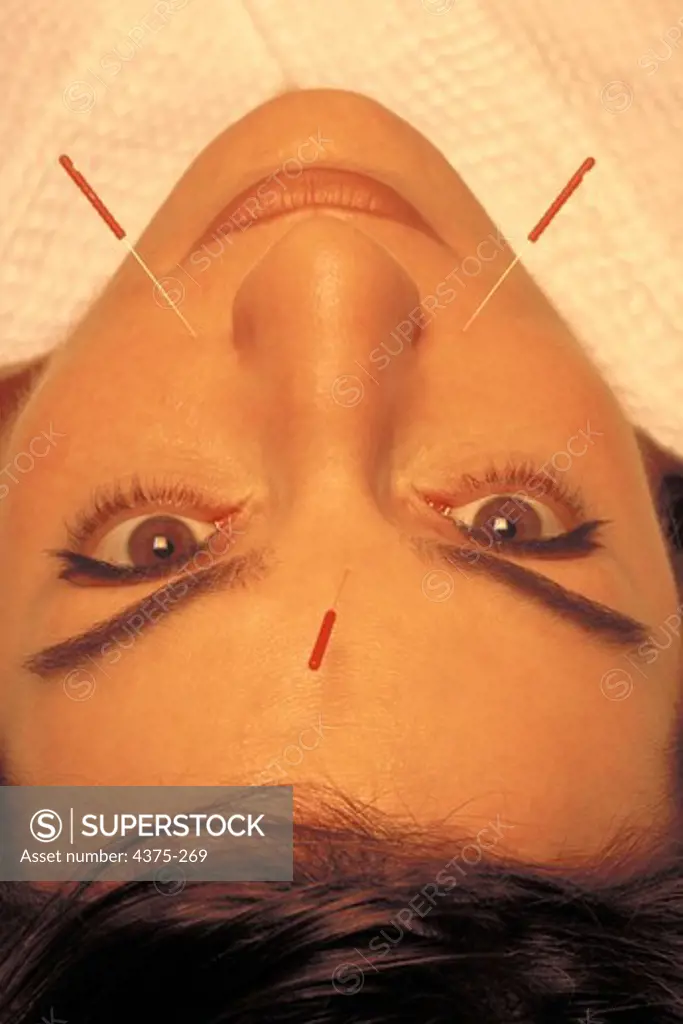 Patient with Acupuncture Needles in Face