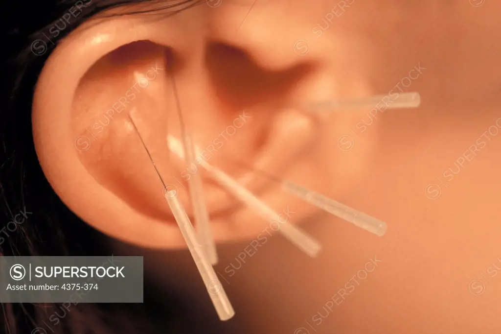 Close-up of Acupuncture Needles in Patient's Ear