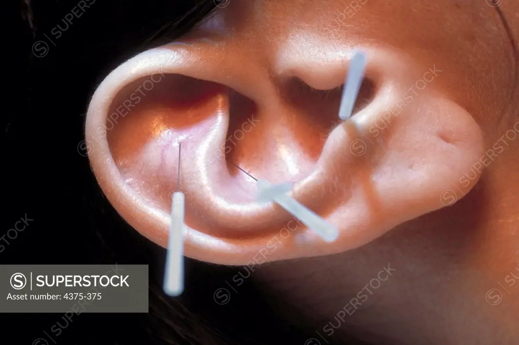 Close-up of Acupuncture Needles in Patient's Ear