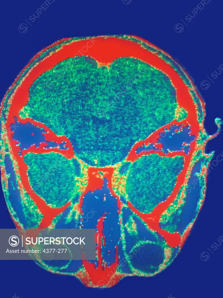 CAT Scan of Optic Nerve Lesion
