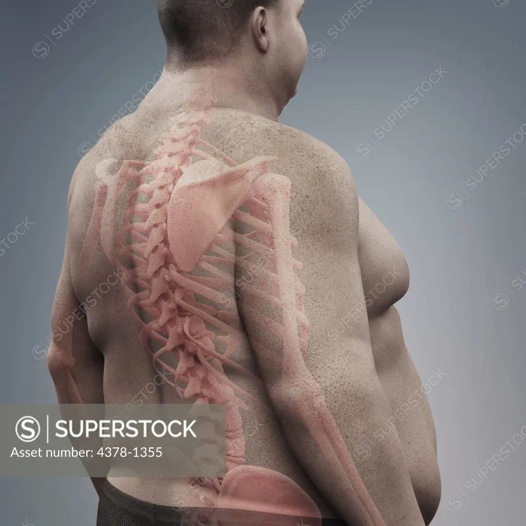 Skeletal structure of the spine layered over overweight man's back to reveal the impact of his condition.