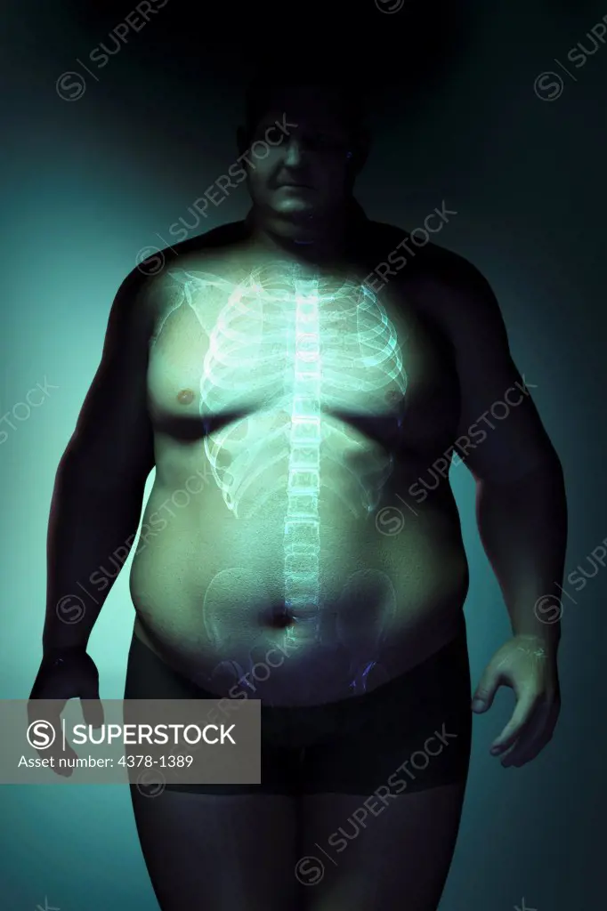 Human skeleton layered over man's body to reveal the severity of his overweight condition.