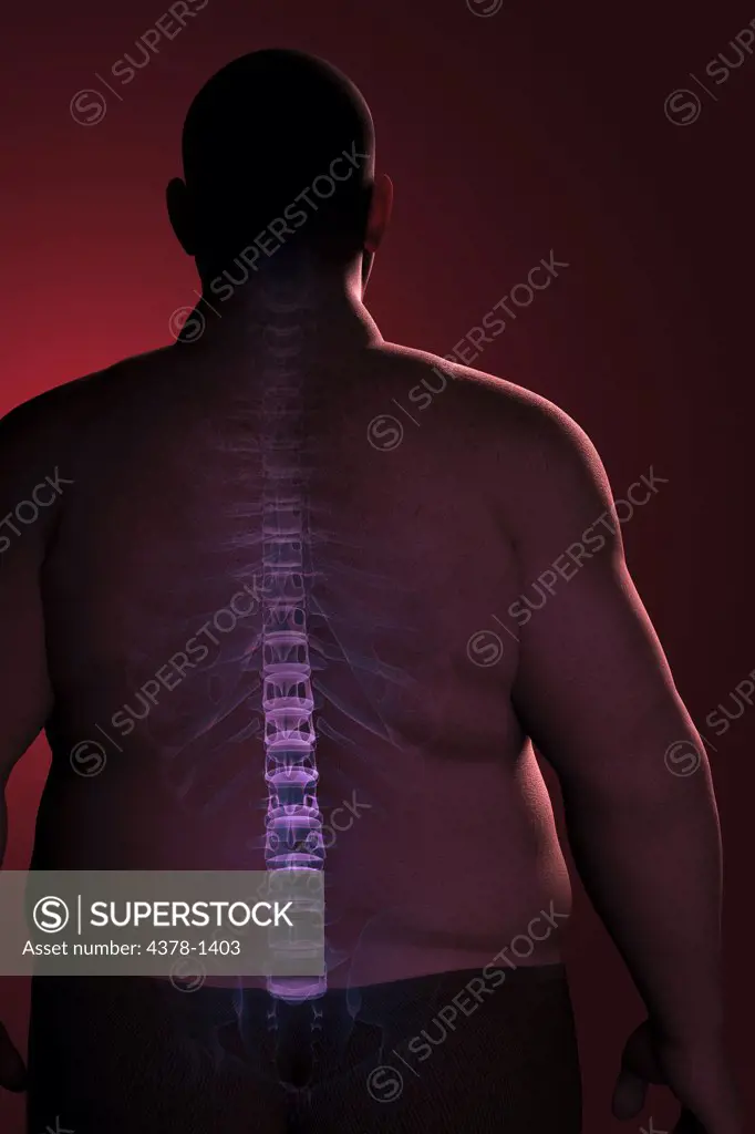 The skeletal structure of the spine and ribs layered over overweight man's back to reveal the impact of his condition.